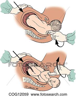 shoulder dystocia outline