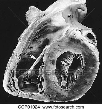 Arquivos de Ilustração - cardíaco,  válvulas, 
 atrioventricular. 
fotosearch - busca 
de ilustrações 
clipeart e desenhos