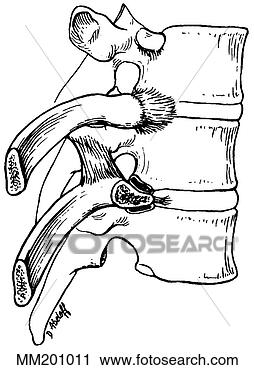 Clipart - ligamentos,  espinhal. 
fotosearch - busca 
de ilustrações 
clipeart e desenhos