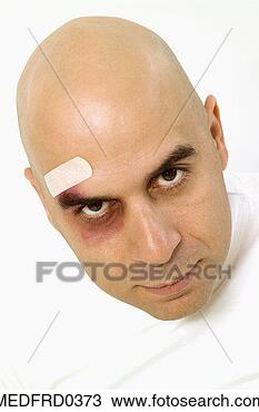 Stock Photo - bald man with 
bandage and black 
eye, close-up. 
fotosearch - search 
stock photos, 
pictures, images, 
and photo clipart
