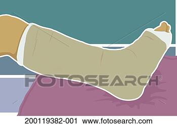 Stock Photography - person's leg in 
plaster cast, 
resting on cushion, 
close-up. fotosearch 
- search stock 
photos, pictures, 
images, and photo 
clipart