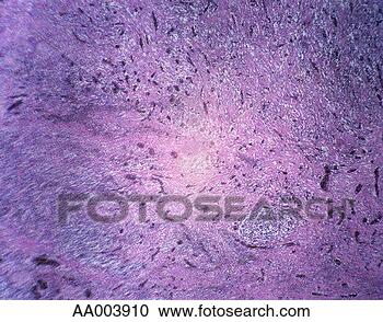 Stock Photography - microscopic image 
of diseased lung 
tissue. fotosearch 
- search stock 
photos, pictures, 
images, and photo 
clipart
