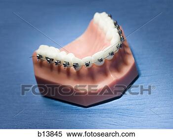 false-teeth-braces_~b13845.jpg