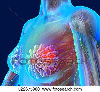 摄影图库 - 乳腺癌, 艺术品 u22675980 - 搜寻照片,壁画,图片和美工