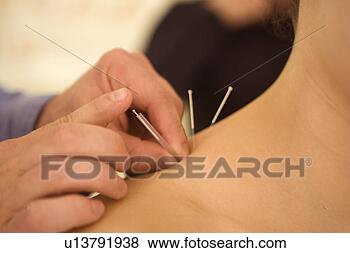Stock Photo - acupuncturist 
working on woman's 
shoulder. fotosearch 
- search stock 
photos, pictures, 
images, and photo 
clipart