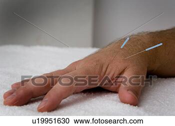 Stock Photography - man receiving 
acupuncture. fotosearch 
- search stock 
photos, pictures, 
images, and photo 
clipart