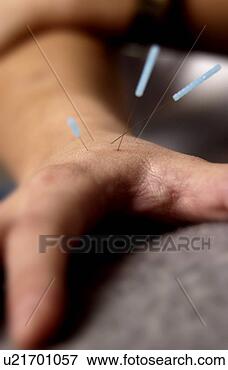 Picture - person receiving 
acupuncture. fotosearch 
- search stock 
photos, pictures, 
images, and photo 
clipart