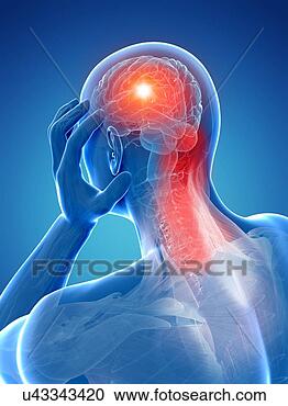 图解或插画 - 头痛, 应付款, 对于, 肌肉痛苦, 艺术