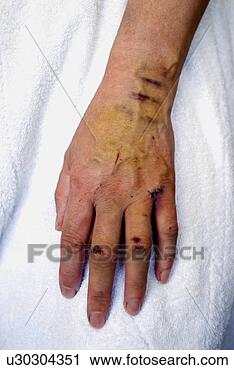 Stock Photography - cuts and bruises 
on a woman's hand. 
fotosearch - search 
stock photos, 
pictures, images, 
and photo clipart