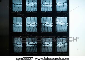 Picture - x-rays of teeth. 
fotosearch - search 
stock photos, 
pictures, images, 
and photo clipart