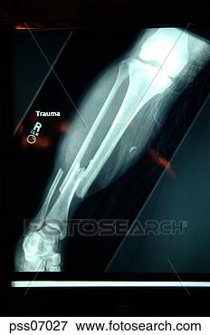 Picture - x-ray of broken 
bone. fotosearch 
- search stock 
photos, pictures, 
images, and photo 
clipart