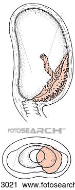 Clipart of An example of partial placenta previa where placenta ...