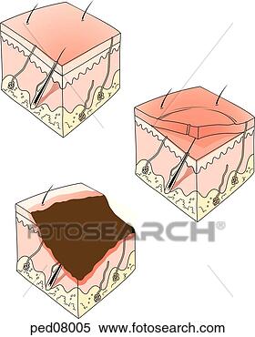 Stock Illustration of Three skin sections showing three levels of burns ...