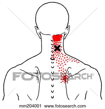 Clipart of Cervical multifidi m., trigger points mm204001 - Search Clip ...