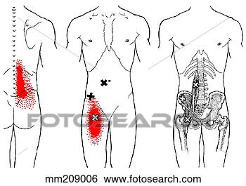 Stock Illustration of Iliopsoas m., trigger points mm209006 - Search ...